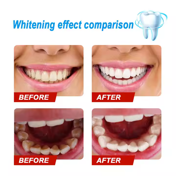 Teeth cleaning  